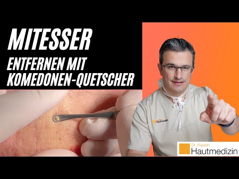 Mitesser entfernen mit Komedonenquetscher: Wie geht das? | Dr. Kasten Hautmedizin in Mainz #mitesser